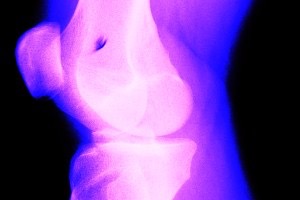 knee pain chiropractic denver